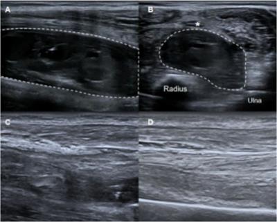 Case report: Ultrasound-guided percutaneous drainage combined with lavage using urokinase: An economical and effective treatment for muscular hematomas in hemophiliacs